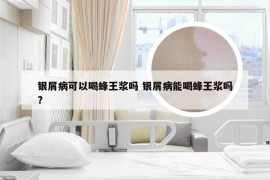 银屑病可以喝蜂王浆吗 银屑病能喝蜂王浆吗?