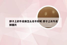脖子上的牛皮癣怎么也不好呢 脖子上长牛皮鲜图片