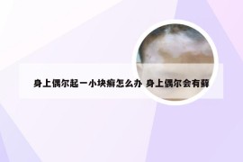 身上偶尔起一小块癣怎么办 身上偶尔会有藓