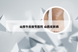 山西牛皮癣专医院 山西皮肤病