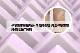 寻常型银屑病临床表现简答题 简述寻常型银屑病的治疗原则