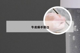 牛皮癣手裂口
