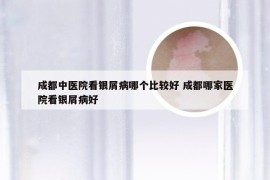 成都中医院看银屑病哪个比较好 成都哪家医院看银屑病好