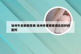 徐州牛皮癣银屑病 徐州市看银屑病比较好的医院