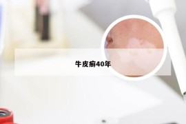 牛皮癣40年