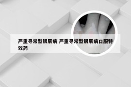 严重寻常型银屑病 严重寻常型银屑病口服特效药