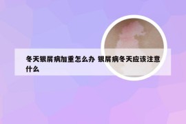 冬天银屑病加重怎么办 银屑病冬天应该注意什么