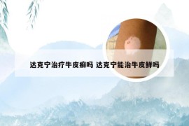 达克宁治疗牛皮癣吗 达克宁能治牛皮鲜吗