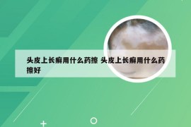 头皮上长癣用什么药擦 头皮上长癣用什么药擦好
