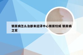 银屑病怎么治都来迎泽中心银屑权威 银屑病之家