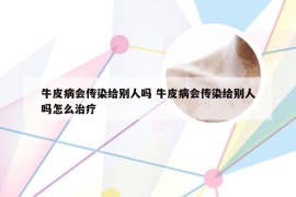 牛皮病会传染给别人吗 牛皮病会传染给别人吗怎么治疗