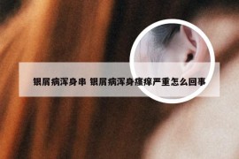 银屑病浑身串 银屑病浑身瘙痒严重怎么回事
