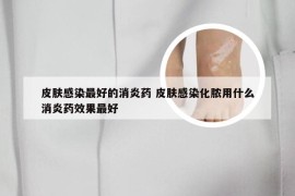 皮肤感染最好的消炎药 皮肤感染化脓用什么消炎药效果最好
