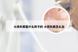 小孩长癣是什么样子的 小孩长癣怎么治