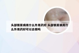 头部银屑病用什么外用药好 头部银屑病用什么外用药好可以去根吗