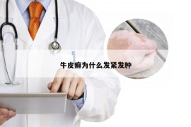 牛皮癣为什么发紧发肿