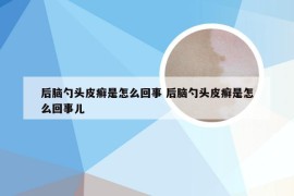 后脑勺头皮癣是怎么回事 后脑勺头皮癣是怎么回事儿