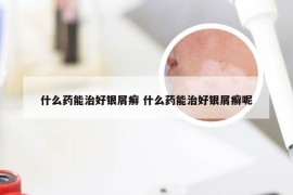 什么药能治好银屑癣 什么药能治好银屑癣呢