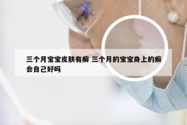 三个月宝宝皮肤有癣 三个月的宝宝身上的癣会自己好吗