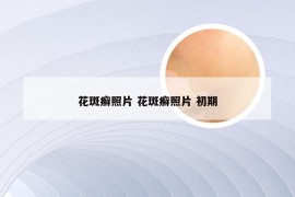 花斑癣照片 花斑癣照片 初期