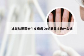 冰蛇肤灵霜治牛皮癣吗 冰蛇肤灵主治什么病