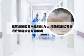 银屑病糠酸莫米松和达力士 糠酸莫米松乳膏治疗银屑病能长期用吗