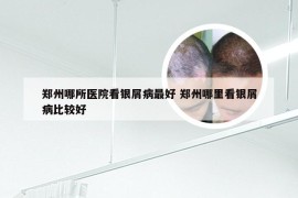 郑州哪所医院看银屑病最好 郑州哪里看银屑病比较好