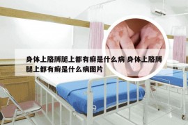 身体上胳膊腿上都有癣是什么病 身体上胳膊腿上都有癣是什么病图片
