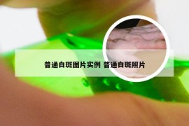 普通白斑图片实例 普通白斑照片