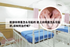 脸部白斑是怎么引起的 脸上白斑是怎么引起的,该如何治疗呢?