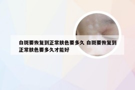 白斑要恢复到正常肤色要多久 白斑要恢复到正常肤色要多久才能好