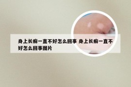 身上长癣一直不好怎么回事 身上长癣一直不好怎么回事图片