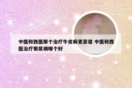 中医和西医那个治疗牛皮癣更靠谱 中医和西医治疗银屑病哪个好