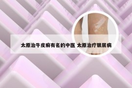 太原治牛皮癣有名的中医 太原治疗银屑病