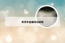 怀孕牛皮癣可以好吗