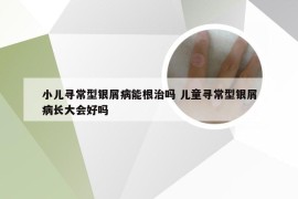 小儿寻常型银屑病能根治吗 儿童寻常型银屑病长大会好吗