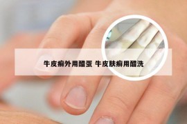 牛皮癣外用醋蛋 牛皮肤癣用醋洗