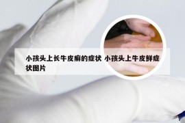 小孩头上长牛皮癣的症状 小孩头上牛皮鲜症状图片