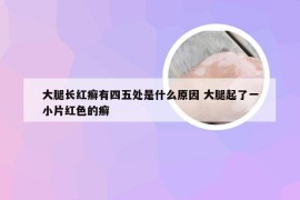 大腿长红癣有四五处是什么原因 大腿起了一小片红色的癣