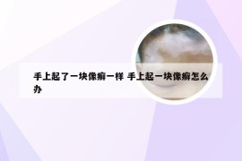 手上起了一块像癣一样 手上起一块像癣怎么办