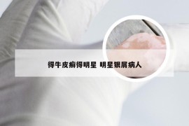 得牛皮癣得明星 明星银屑病人