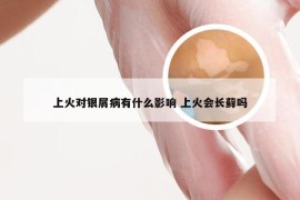 上火对银屑病有什么影响 上火会长藓吗