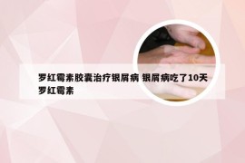 罗红霉素胶囊治疗银屑病 银屑病吃了10天罗红霉素