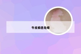 牛皮癣患处痒