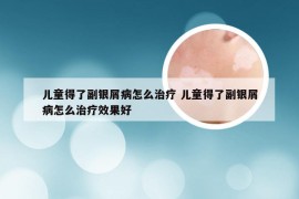 儿童得了副银屑病怎么治疗 儿童得了副银屑病怎么治疗效果好