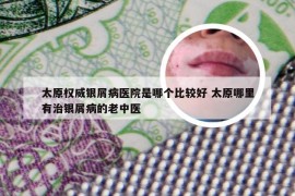 太原权威银屑病医院是哪个比较好 太原哪里有治银屑病的老中医