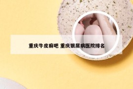 重庆牛皮癣吧 重庆银屑病医院排名