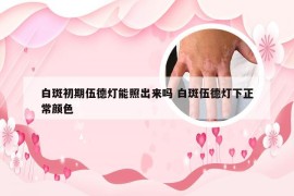 白斑初期伍德灯能照出来吗 白斑伍德灯下正常颜色