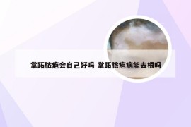 掌跖脓疱会自己好吗 掌跖脓疱病能去根吗