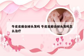 牛皮皮癣会掉头发吗 牛皮皮癣会掉头发吗怎么治疗